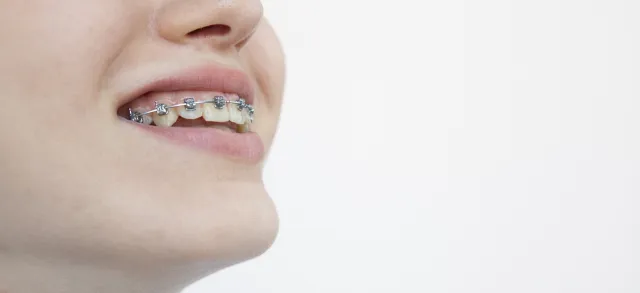大宮駅の歯医者「アーバン歯科・矯正歯科 大宮ラクーン院」のワイヤー矯正はほとんどの不正咬合に対応可能です