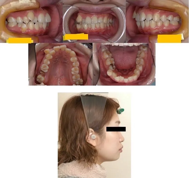 大宮駅の歯医者「アーバン歯科・矯正歯科 大宮ラクーン院」のワイヤー矯正施術前の状態です