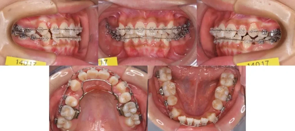 大宮駅の歯医者「アーバン歯科・矯正歯科 大宮ラクーン院」のワイヤー矯正施術中の状態です