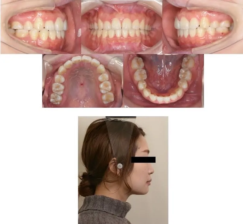 大宮駅の歯医者「アーバン歯科・矯正歯科 大宮ラクーン院」のワイヤー矯正施術後の状態です